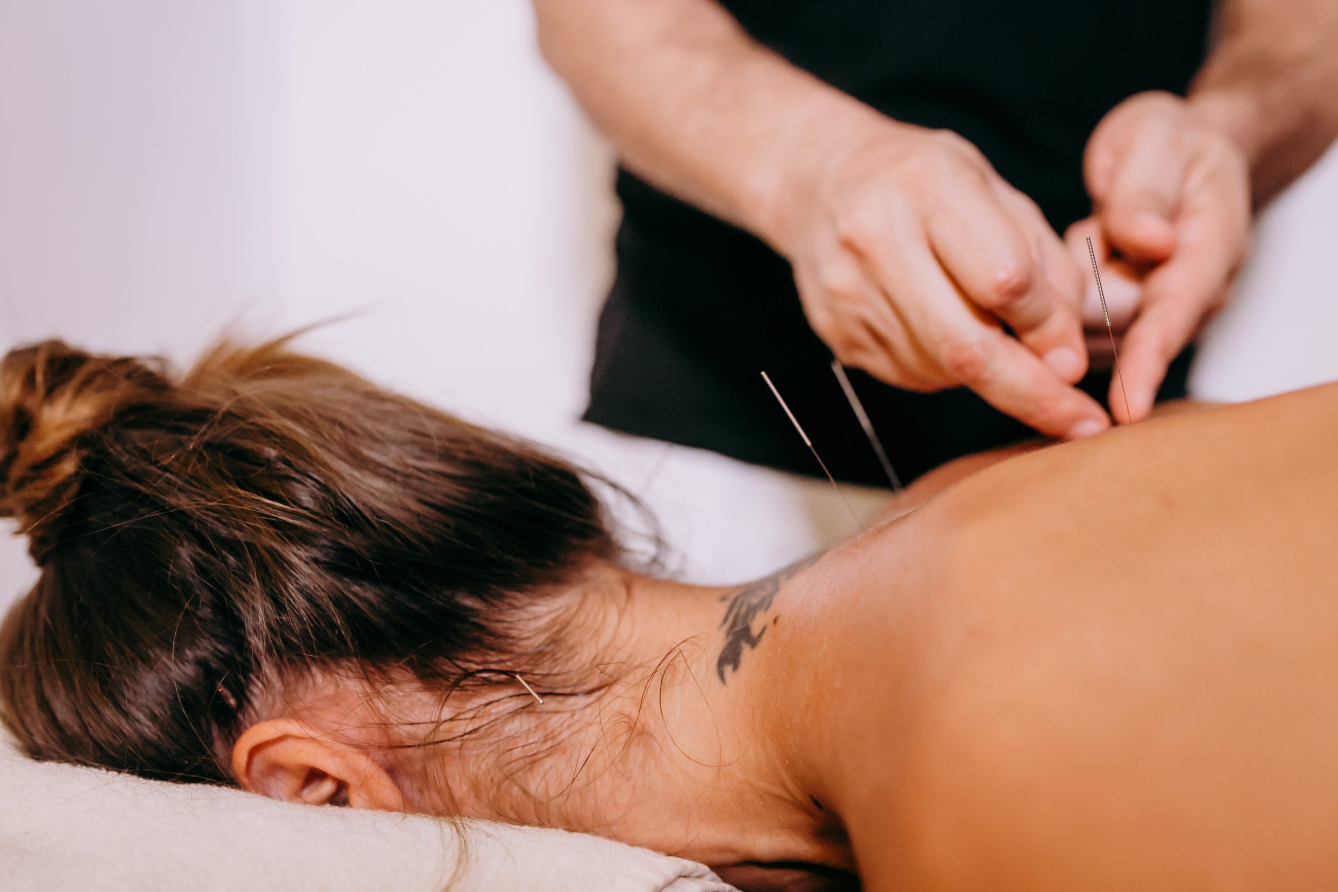 Femme allongée en pleine séance d'acupuncture