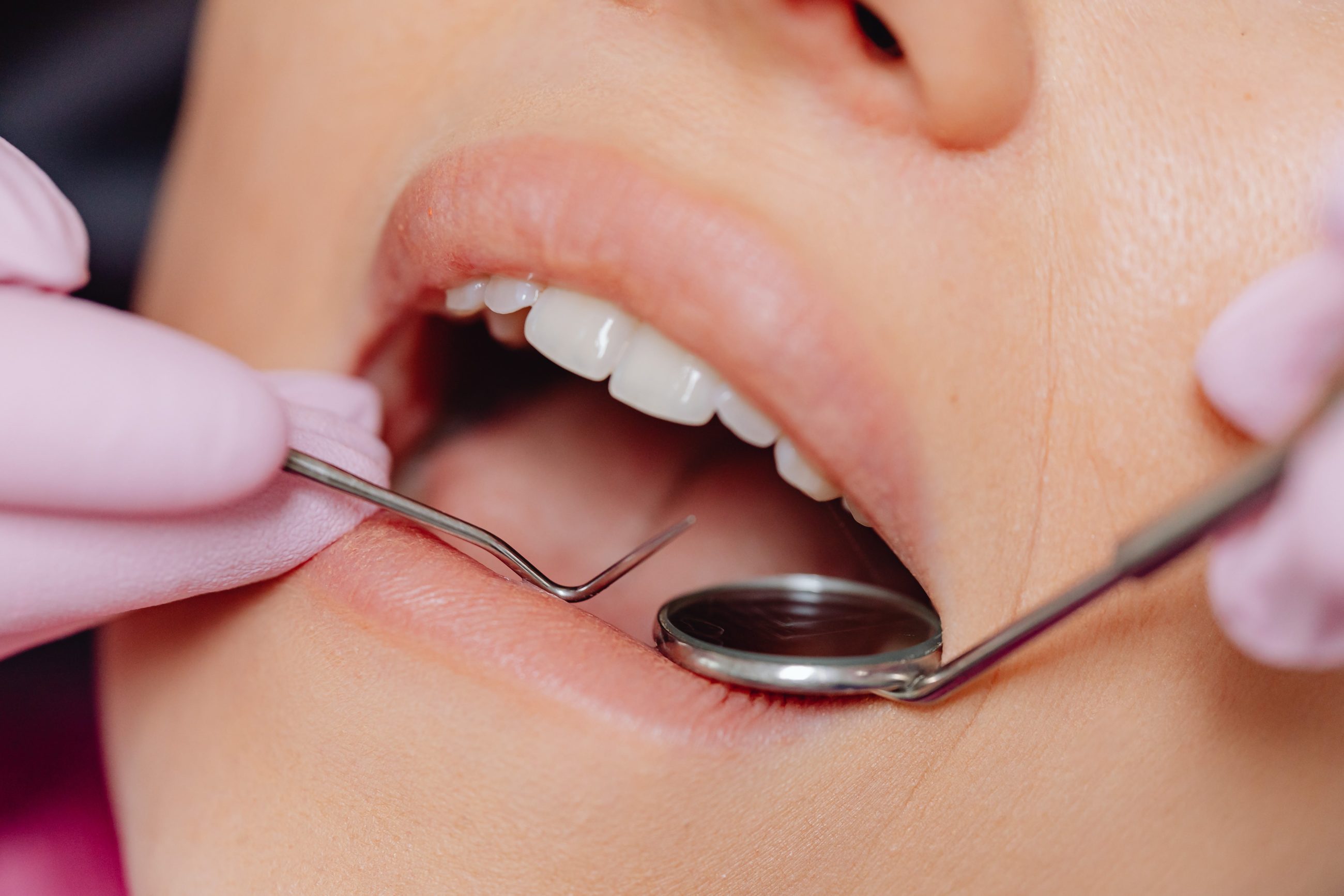 gros-plan sur une bouche ouverte chez le dentiste.